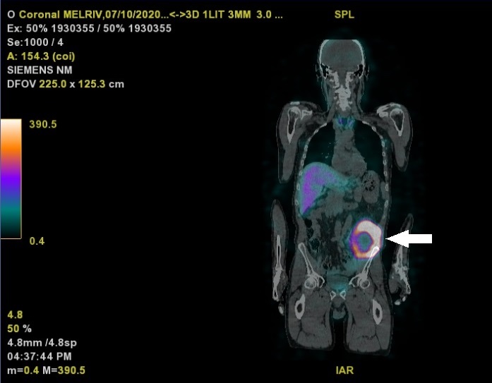 65 yr patient with metastatic melanoma.  SPECT/CT (coronal view) performed 7 days after injection of 1400 MBq/m² of  [131I]ICF01012. Peritoneal lesion with central necrosis (arrow). First into humal clinical trial 