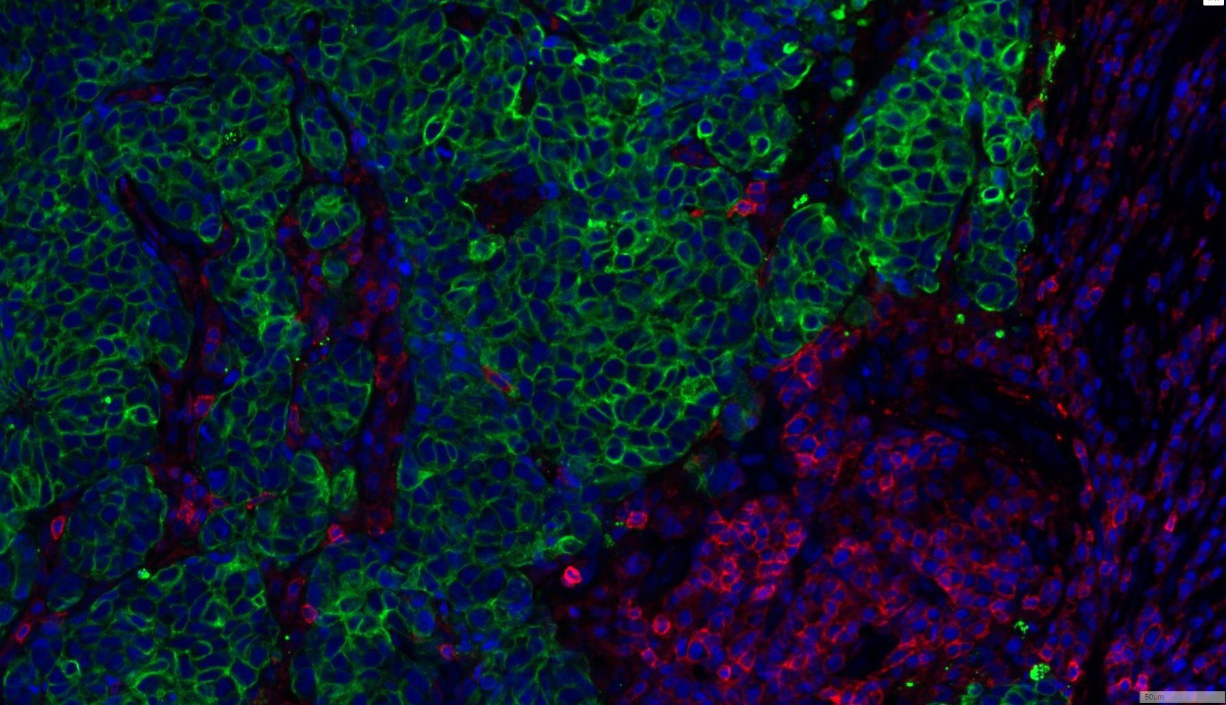 Exploration de l'infiltrat immun grâce au GeoMx - Digital Spatial Profiler (Nanostring) : DAPI (bleu), CD45 (rouge) et panCK (Vert).