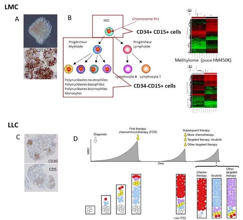 A and C: Identification of CML and CLL cells in medullary hematoma. B: Demonstration of intra-clonal epigenetic heterogeneity (DNA methylation) of the CML clone at diagnosis. D: Subclonal genetic evolution of CLL