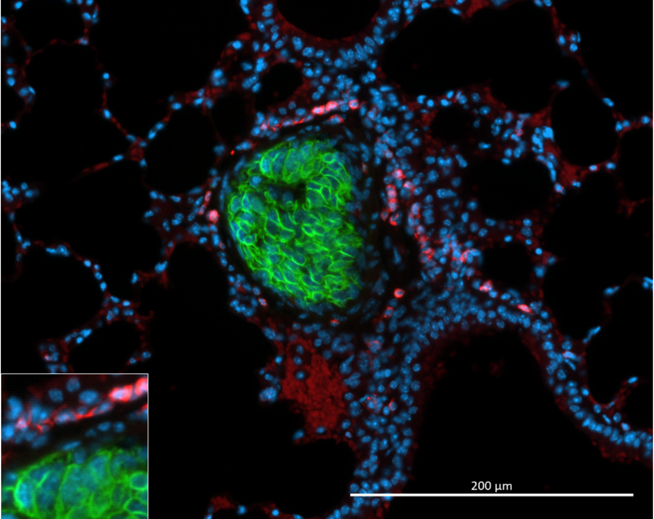 Métastase pulmonaire de CCS dans des souris KO pour Znrf3 et Tp53 (marquée par la GFP, en vert). Elle est entourée de cellules immunitaires positives pour CD45 (rouge) qui n’infiltrent pas le tissu métastatique.