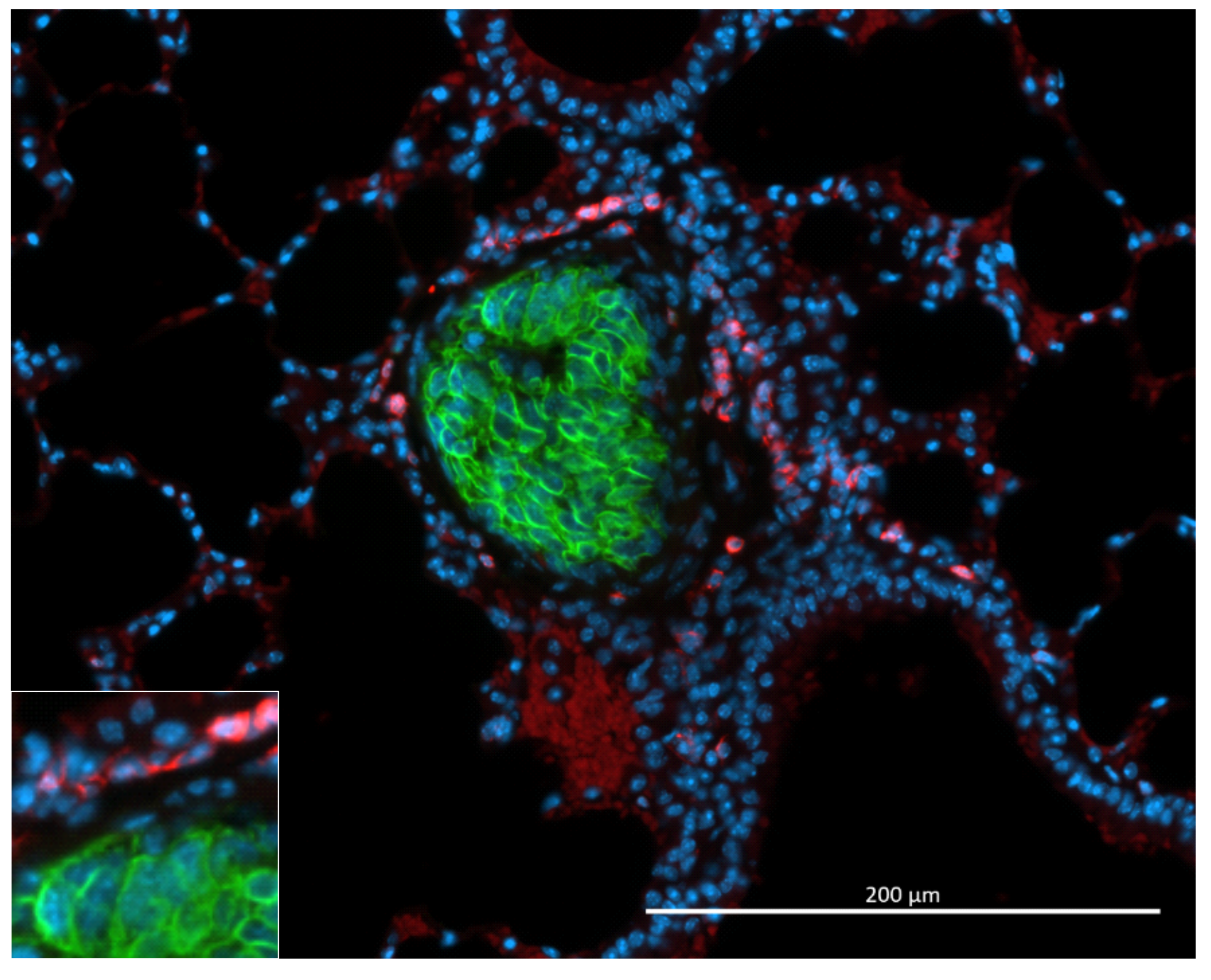 Lung metastasis of ACC from Znrf3 and TP53 double KO mice (stained by GFP in green). It is surrounded by CD45+ immune cells (red) that do not infiltrate metastatic tissue.