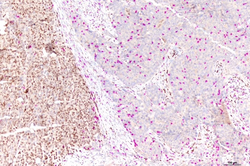 Le tissu du cancer mammaire ‘triple négatif’ coloré en immunohistochimie double.  La zone riche en cellules tumorales Zeb1+ (signal marron) est très pauvre en lymphocytes CD8+, anti-tumoraux (signal violet). Ouled-Dhaou M, ... , Radosevic-Robin N, Am J Ca