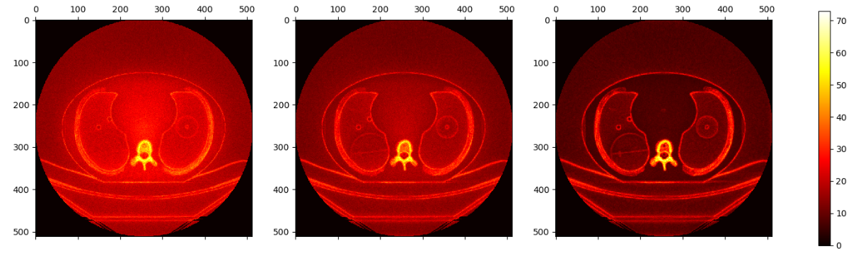 X-ray computed tomography : Image quality (noise) assessment using an anthropomorphic phantom for different iterative algorithm level. 